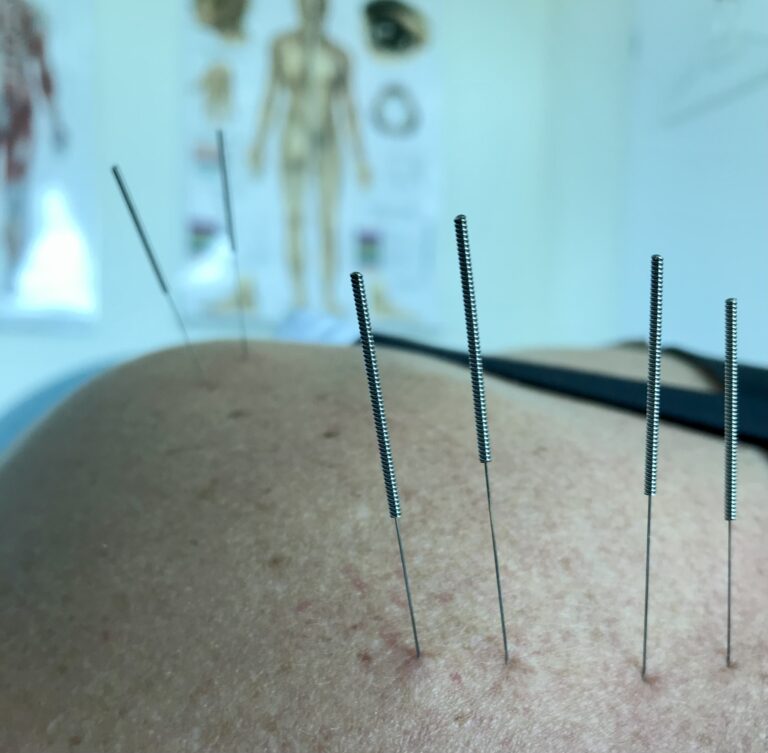 Akupunktura metodą łagodzącą ból